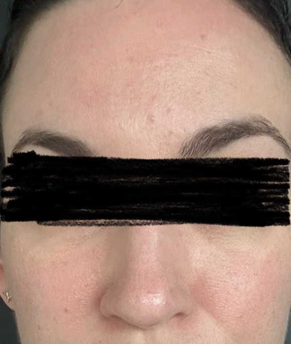 fungal acne after treatment