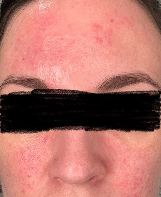 fungal acne before treatment